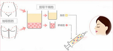 自体脂肪填充原理