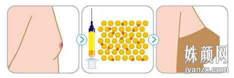 自体脂肪丰胸