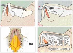 驼峰鼻矫正术