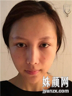 郑州俪侬医疗美容整形李会勇自体脂肪全脸恢复图