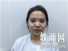 北京叶美人医疗美容诊所 张伟自体脂肪填充术前图