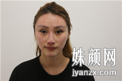 北京叶美人医疗美容诊所张伟自体脂肪全脸术前图