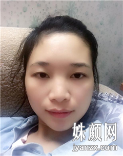 深圳弘美医疗美容门诊部薛铁华术前图